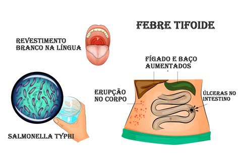 febre tifoide sintomas - sintomas da gripe h1n1